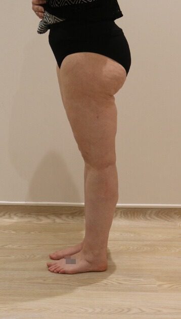Lipoedema liposuction after left lateral 1
