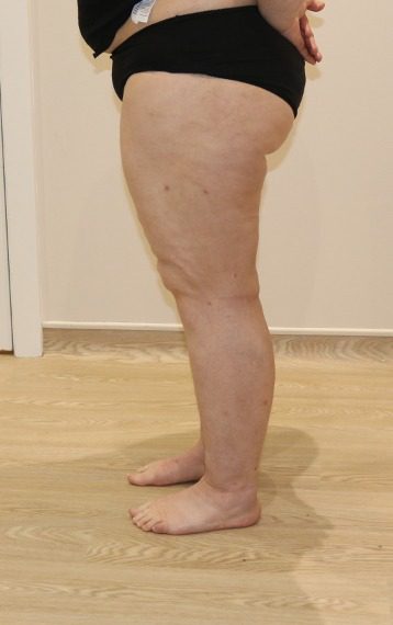 Lipoedema liposuction after left lateral 2