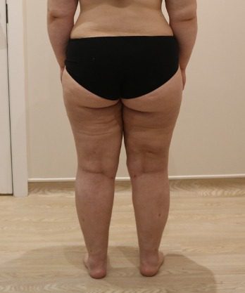 Lipoedema liposuction after posterior thighs
