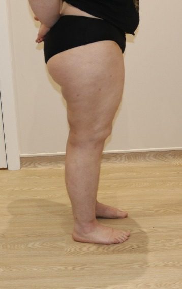 Lipoedema liposuction after right lateral 1
