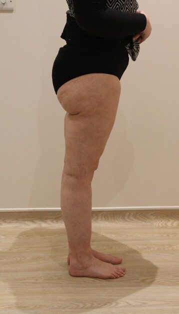Lipoedema liposuction after right lateral