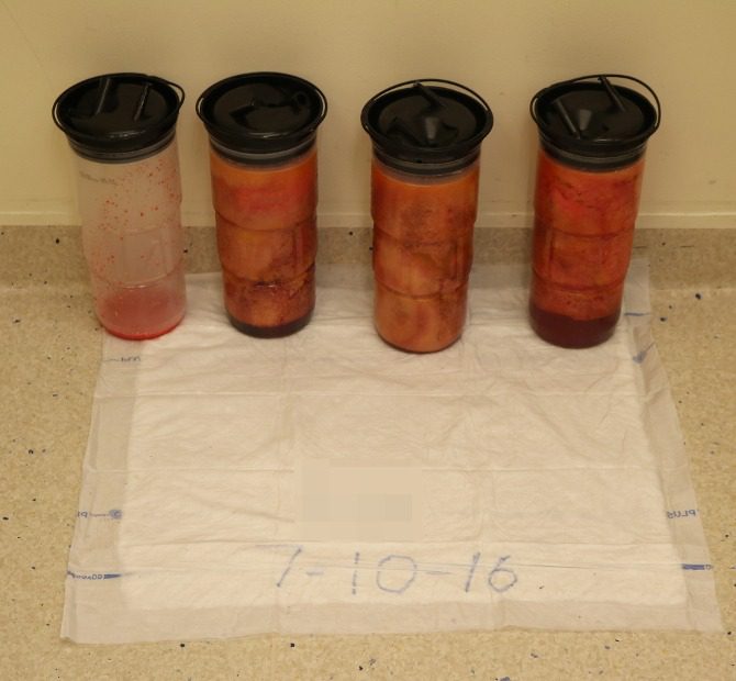 Lipoedema liposuction aspirated fat stage 3