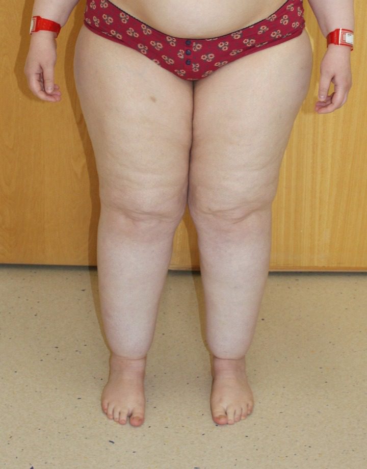 Lipoedema liposuction before AP view 1