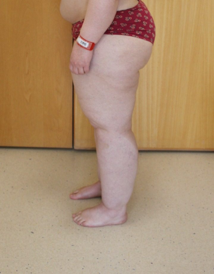 Lipoedema liposuction before left lateral 1