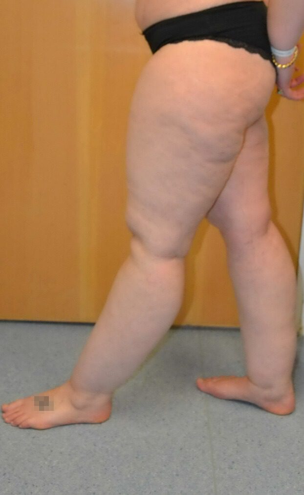 Lipoedema liposuction before left lateral