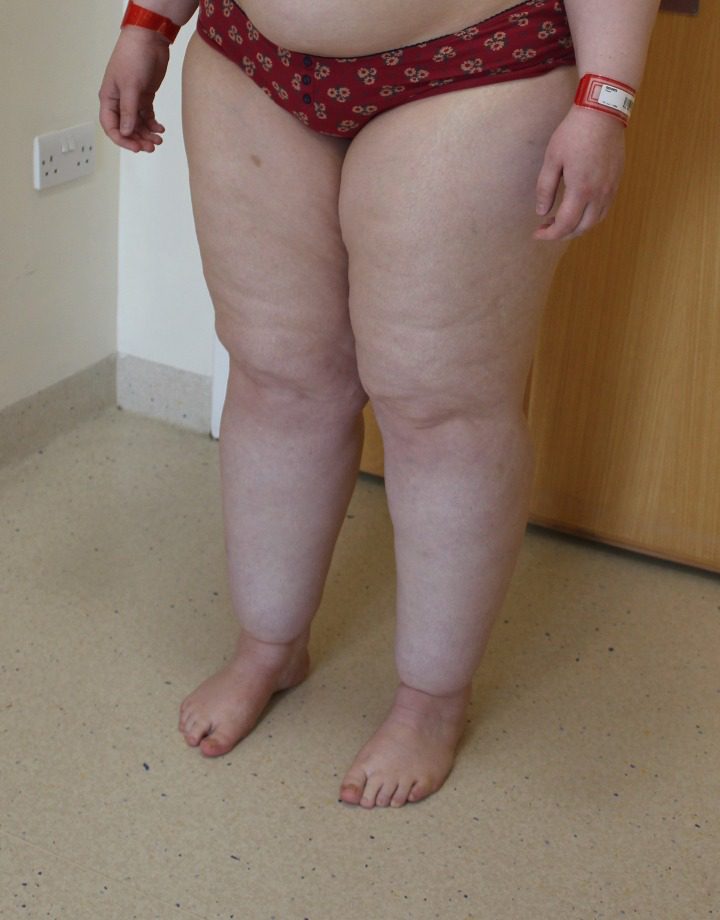 Lipoedema liposuction before left oblique 1