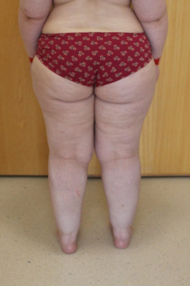 Lipoedema liposuction before posterior thighs