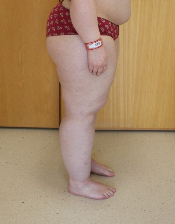 Lipoedema liposuction before right lateral 1