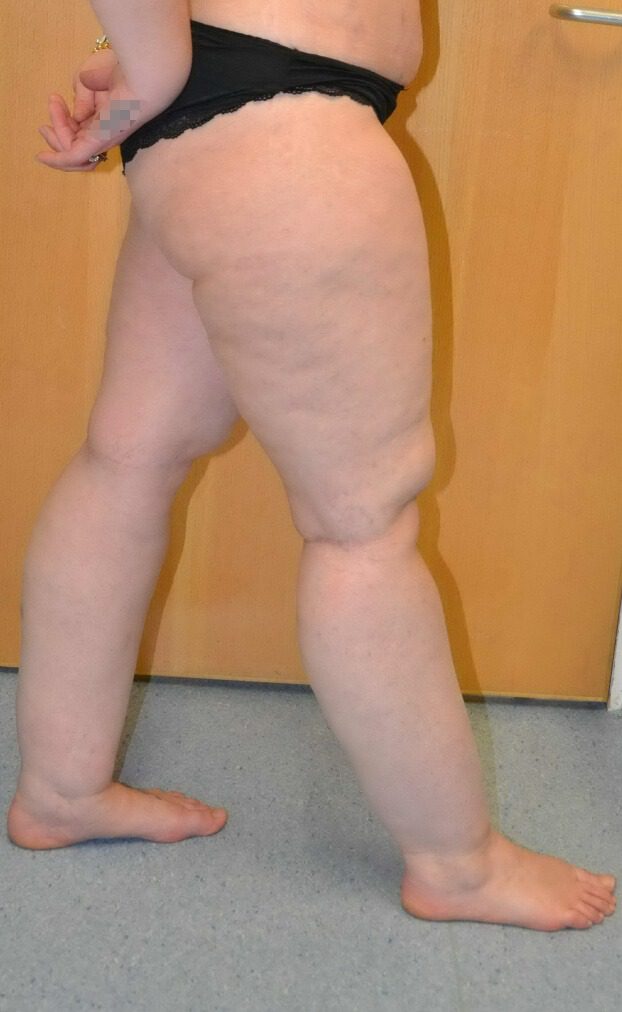 Lipoedema liposuction before right lateral