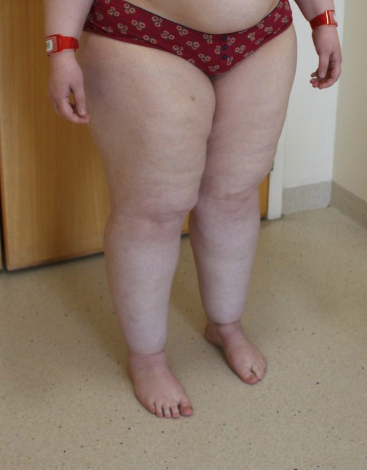 Lipoedema liposuction before right oblique 1