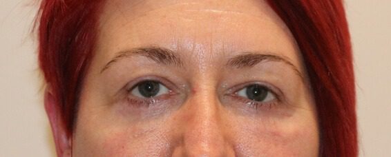Lower blepharoplasty after AP view