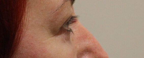 Lower blepharoplasty after right lateral
