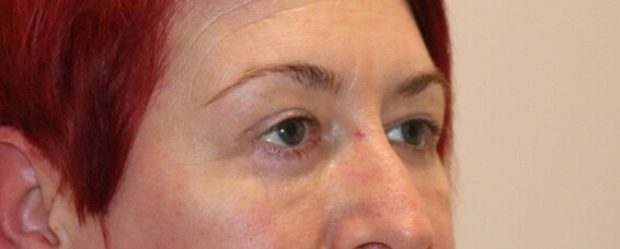Lower blepharoplasty after right oblique