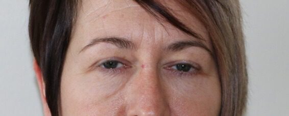 Lower blepharoplasty before AP view