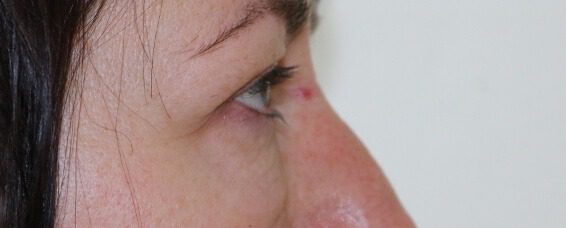 Lower blepharoplasty before right lateral