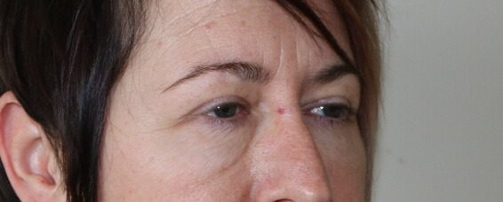 Lower blepharoplasty before right oblique