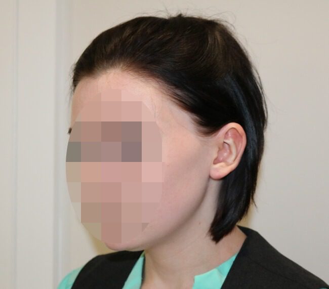 Prominent ear correction after left oblique