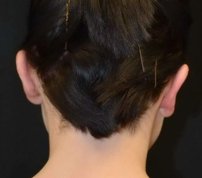 Prominent ear correction after posterior view