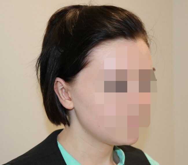 Prominent ear correction after right oblique