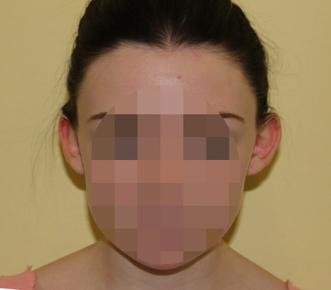 Prominent ear correction before AP view