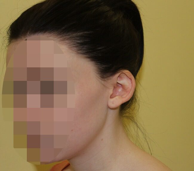 Prominent ear correction before left oblique