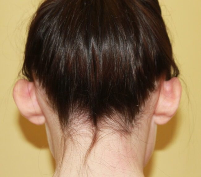Prominent ear correction before posterior view