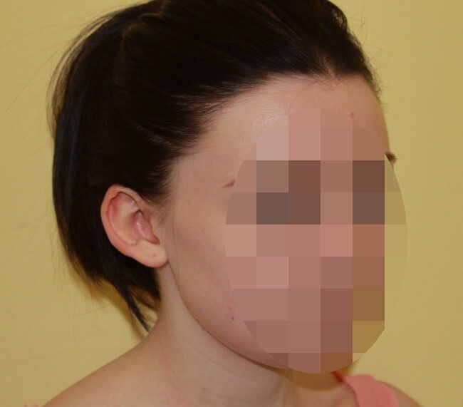 Prominent ear correction before right oblique
