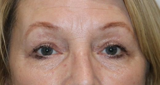 Upper blepharoplasty after AP view