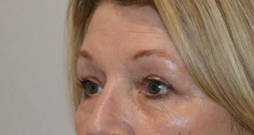 Upper blepharoplasty after left oblique