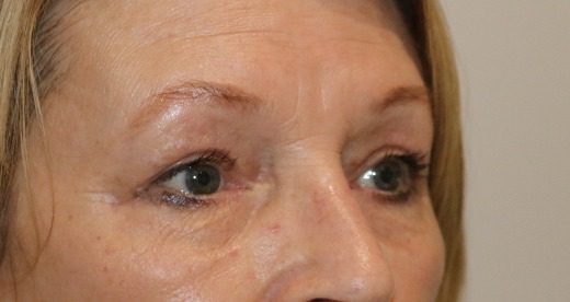 Upper blepharoplasty after right oblique