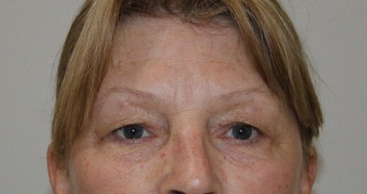 Upper blepharoplasty before AP view