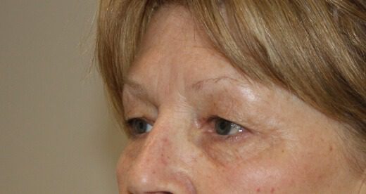 Upper blepharoplasty before left oblique