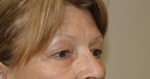 Upper blepharoplasty before right oblique