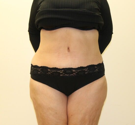 Brazilian tummy tuck after AP view