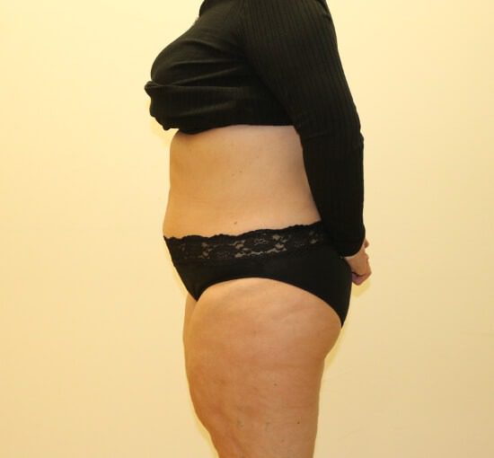 Brazilian tummy tuck after left lateral