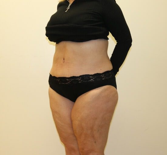 Brazilian tummy tuck after left oblique