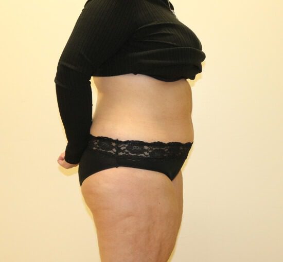 Brazilian tummy tuck after right lateral