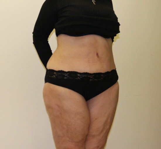 Brazilian tummy tuck after right oblique