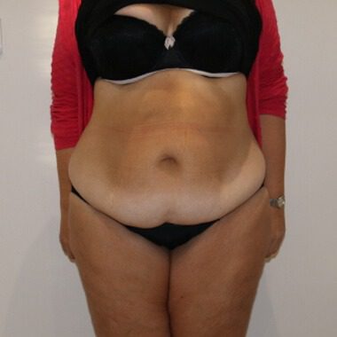 Brazilian tummy tuck before AP view