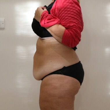 Brazilian tummy tuck before left lateral 1