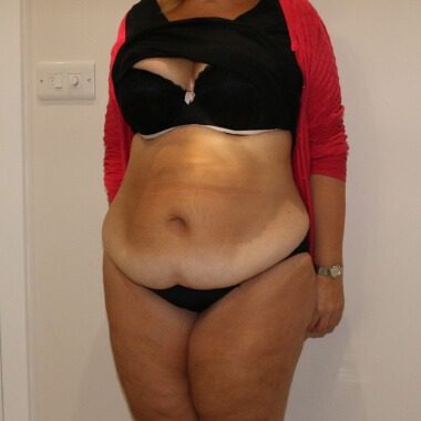 Brazilian tummy tuck before left oblique