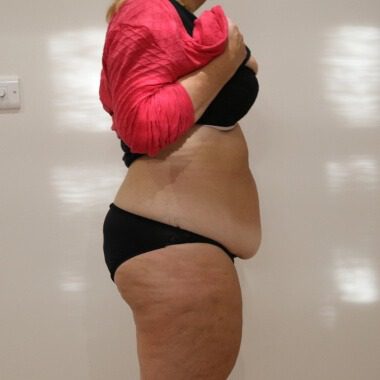 Brazilian tummy tuck before right lateral 1