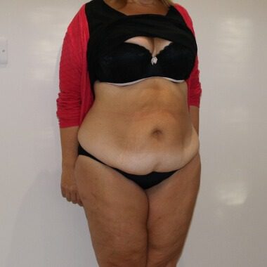 Brazilian tummy tuck before right oblique