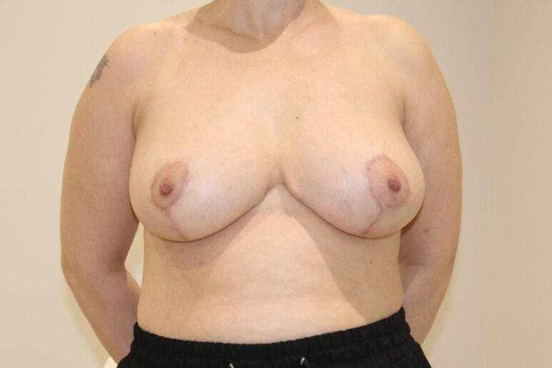 Breast reduction Wise pattern after AP view