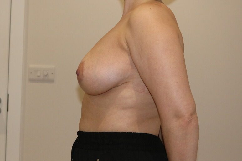 Breast reduction Wise pattern after left lateral