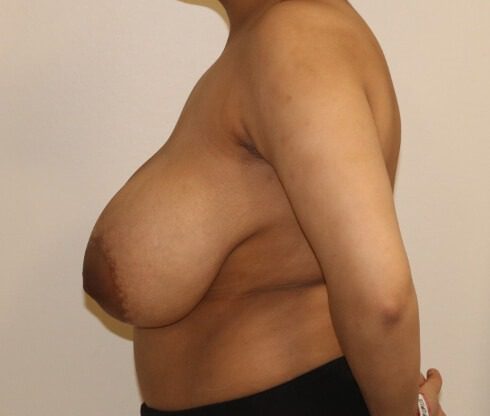 Breast reduction vertical scar before left lateral
