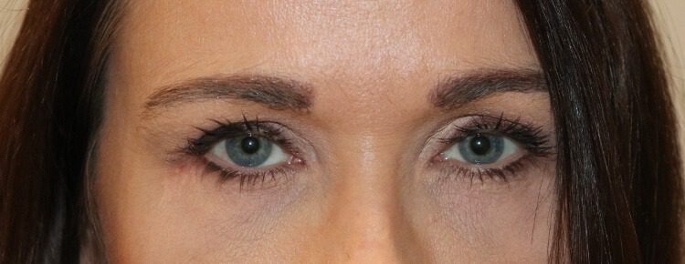 Lower blepharoplasty after AP view