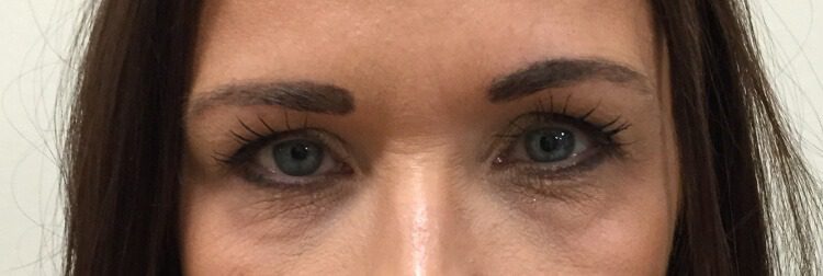 Lower blepharoplasty before AP view 1