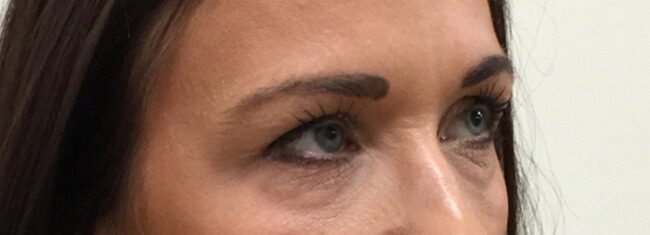 Lower blepharoplasty before right oblique 1