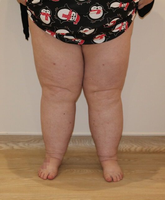 Lower limb lipoedema liposuction after AP view